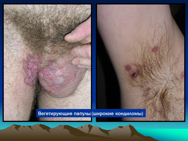 Вегетирующие папулы (широкие кондиломы)